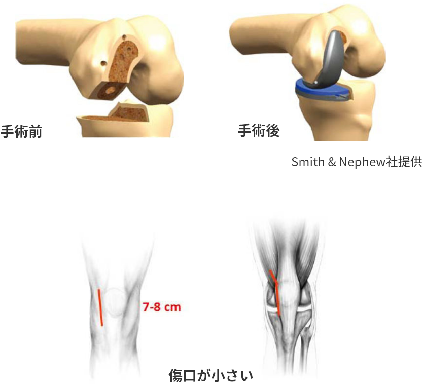 変形性膝関節症の治療はおまかせください、3D技術を活用し体に負担の 